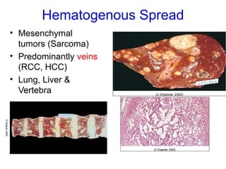 Hematogenous Spread
• Mesenchymal
tumors (Sarcoma)
• Predominantly veins
(RCC, HCC)
• Lung, Liver &
Vertebra
 