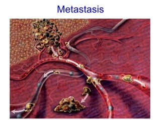 Metastasis
 