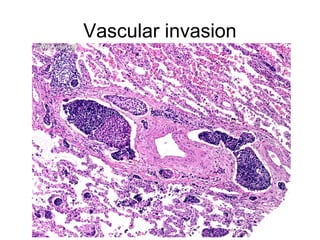 Vascular invasion
 