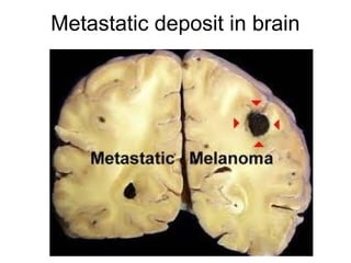 Metastatic deposit in brain
 