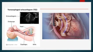 Invasive And Non Invasive Comprehensive Overview of Invasive and Non-Invasive Cardiac Procedures ...