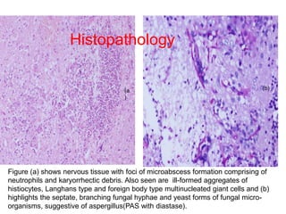 Invasive aspergillosis | PPT