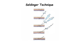 Seldinger Technique
 