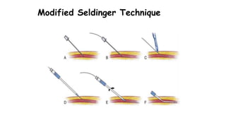 Modified Seldinger Technique
 