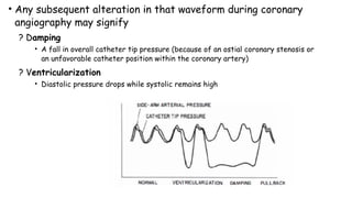 • Any subsequent alteration in that waveform during coronary
angiography may signify
? Damping
• A fall in overall catheter tip pressure (because of an ostial coronary stenosis or
an unfavorable catheter position within the coronary artery)
? Ventricularization
• Diastolic pressure drops while systolic remains high
 