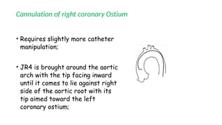 Cannulation of right coronary Ostium
• Requires slightly more catheter
manipulation;
• JR4 is brought around the aortic
arch with the tip facing inward
until it comes to lie against right
side of the aortic root with its
tip aimed toward the left
coronary ostium;
 