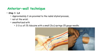 Anterior-wall technique
• Step 1: LA
• Approximately 2 cm proximal to the radial styloid process,
• not at the wrist;
• anesthetized with
• 2-3 cc of 1% lidocaine with a small (3cc) syringe 25 gauge needle;
 