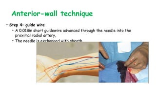 Anterior-wall technique
• Step 4: guide wire
• A 0.018in short guidewire advanced through the needle into the
proximal radial artery,
• The needle is exchanged with sheath
 