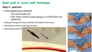 Dual-wall or back-wall technique,
Step 2: puncture
• A micropuncture catheter
• fine metal needle and
• 22G Teflon catheter (allow passage of a 0.018-0.021 inch
guidewire);
• Advanced through the front wall Into the lumen of the artery
• until blood is noticed in the hub and then
• intentionally pushed through the back wall of the Artery
 