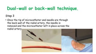 Dual-wall or back-wall technique,
Step 3
• Once the tip of microcatheter and needle are through
the back wall of the radial artery, the needle is
removed and the microcatheter left in place across the
radial artery
 