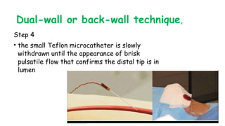 Dual-wall or back-wall technique,
Step 4
• the small Teflon microcatheter is slowly
withdrawn until the appearance of brisk
pulsatile flow that confirms the distal tip is in
lumen
 
