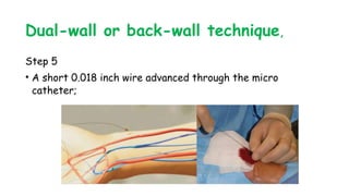 Dual-wall or back-wall technique,
Step 5
• A short 0.018 inch wire advanced through the micro
catheter;
 