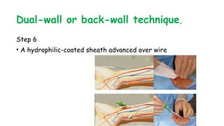 Dual-wall or back-wall technique,
Step 6
• A hydrophilic-coated sheath advanced over wire
 