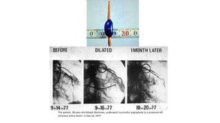 The patient, 38-year-old Adolph Bachman, underwent successful angioplasty to a proximal left
coronary artery lesion in Sep.16, 1977
 