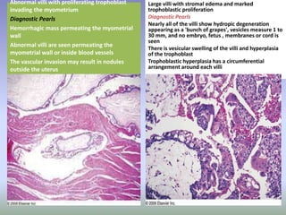 Large villi with stromaledema and marked trophoblastic proliferationDiagnostic PearlsNearly all of the villi show hydropic degeneration appearing as a 'bunch of grapes', vesicles measure 1 to 30 mm, and no embryo, fetus , membranes or cord is seen There is vesicular swelling of the villi and hyperplasia of the trophoblastTrophoblastic hyperplasia has a circumferential arrangement around each villiAbnormal villi with proliferating trophoblast invading the myometriumDiagnostic PearlsHemorrhagic mass permeating the myometrial wall Abnormal villi are seen permeating the myometrial wall or inside blood vessels The vascular invasion may result in nodules outside the uterus 