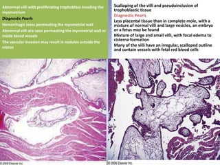 Scalloping of the villi and pseudoinclusion of trophoblastic tissueDiagnostic PearlsLess placental tissue than in complete mole, with a mixture of normal villi and large vesicles, an embryo or a fetus may be found Mixture of large and small villi, with focal edema to cisterna formation Many of the villi have an irregular, scalloped outline and contain vessels with fetal red blood cells Abnormal villi with proliferating trophoblast invading the myometriumDiagnostic PearlsHemorrhagic mass permeating the myometrial wall Abnormal villi are seen permeating the myometrial wall or inside blood vessels The vascular invasion may result in nodules outside the uterus 