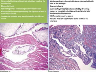 Admixture of syncytiotrophoblast and cytotrophoblast is seen in this exampleDiagnostic PearlsClusters of cytotrophoblast separated by streaming masses of syncytiotrophoblast, with a characteristic dimophicplexiform pattern Villi formation must be absent Vascular invasion is commonly found and may be extensiveAbnormal villi with proliferating trophoblast invading the myometriumDiagnostic PearlsHemorrhagic mass permeating the myometrial wall Abnormal villi are seen permeating the myometrial wall or inside blood vessels The vascular invasion may result in nodules outside the uterus 