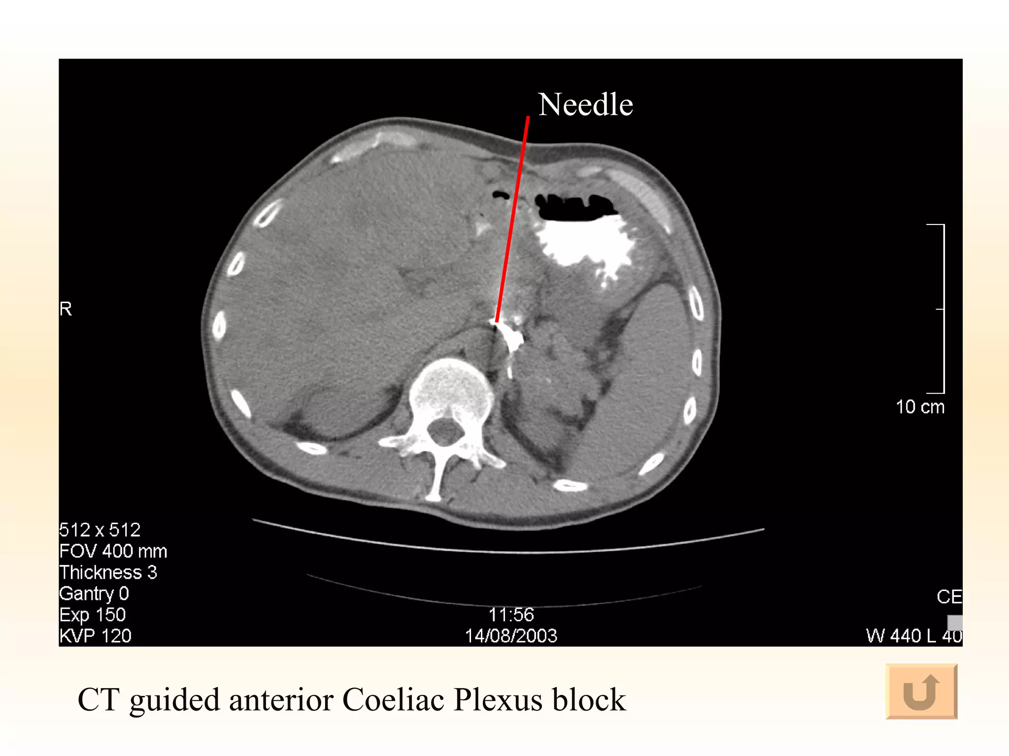 CT guided anterior Coeliac Plexus block Needle 