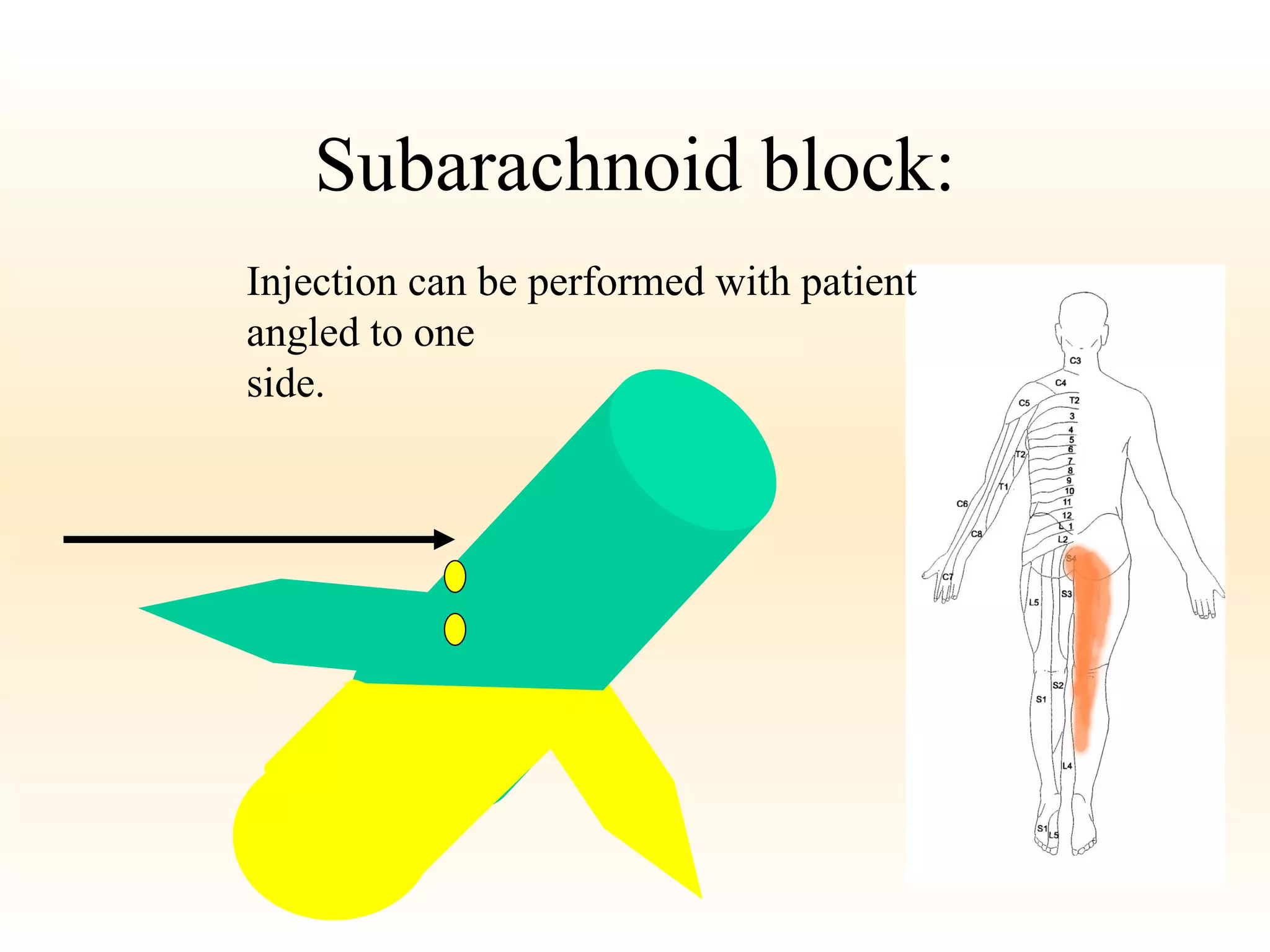 Subarachnoid block: Injection can be performed with patient  angled to one  side. 