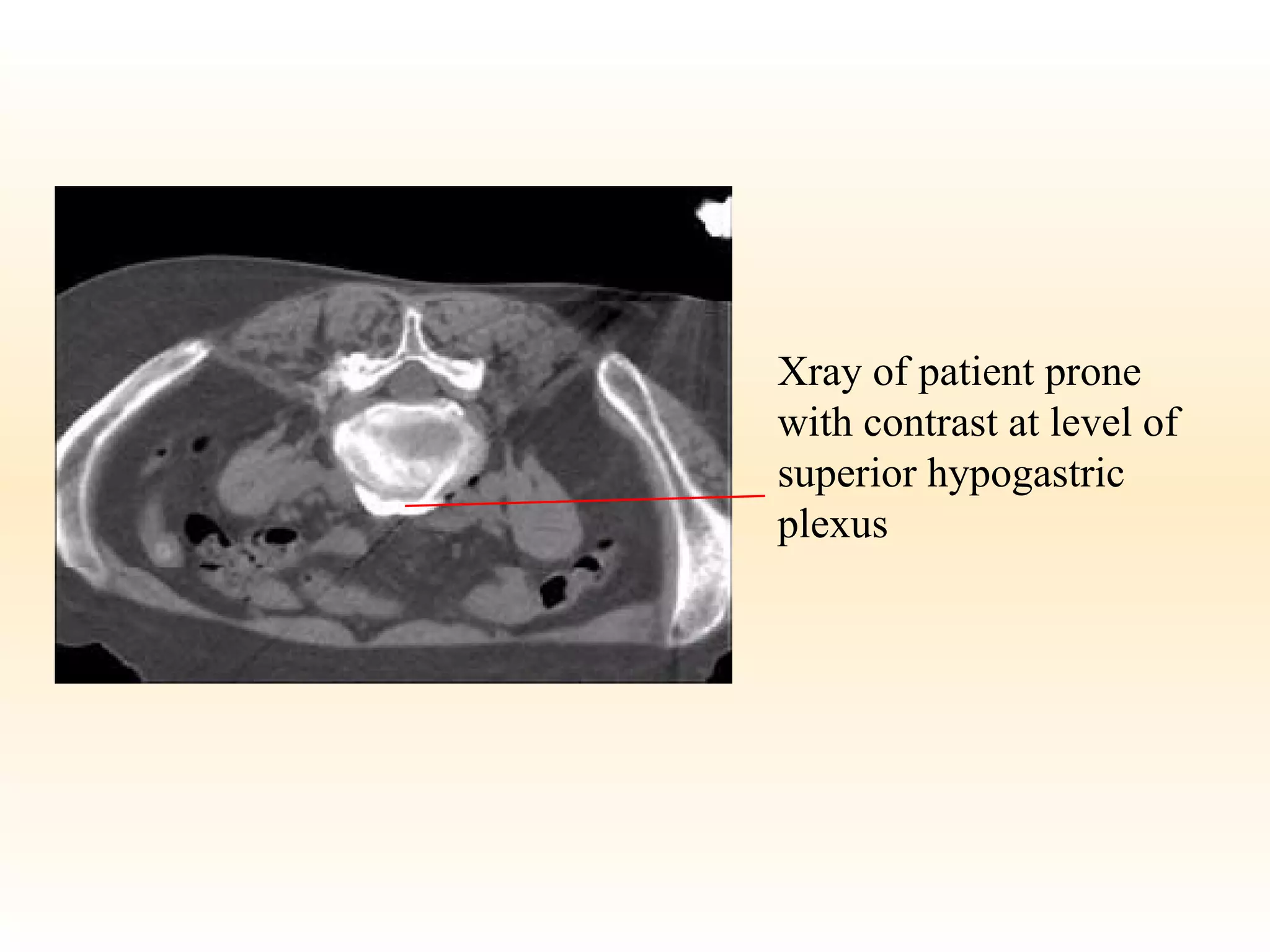 Xray of patient prone with contrast at level of superior hypogastric plexus 