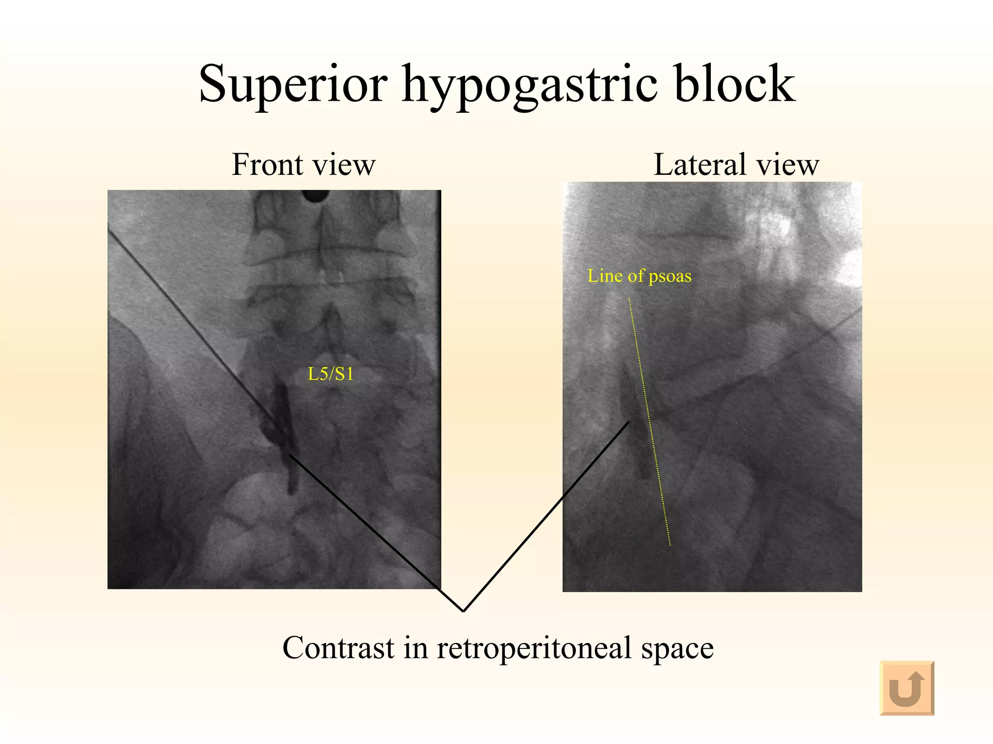 Superior hypogastric block L5/S1 Line of psoas Contrast in retroperitoneal space Front view Lateral view 