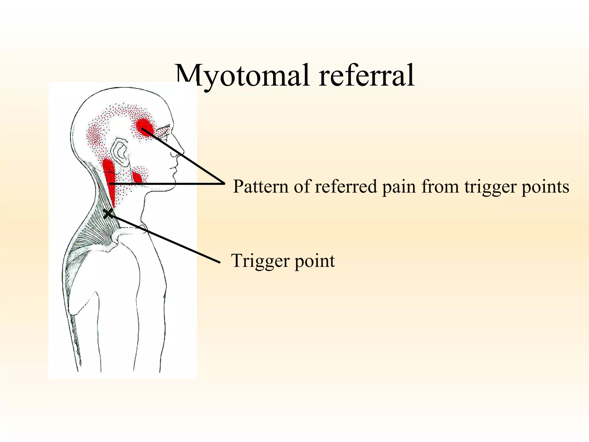 Myotomal referral Pattern of referred pain from trigger points Trigger point 