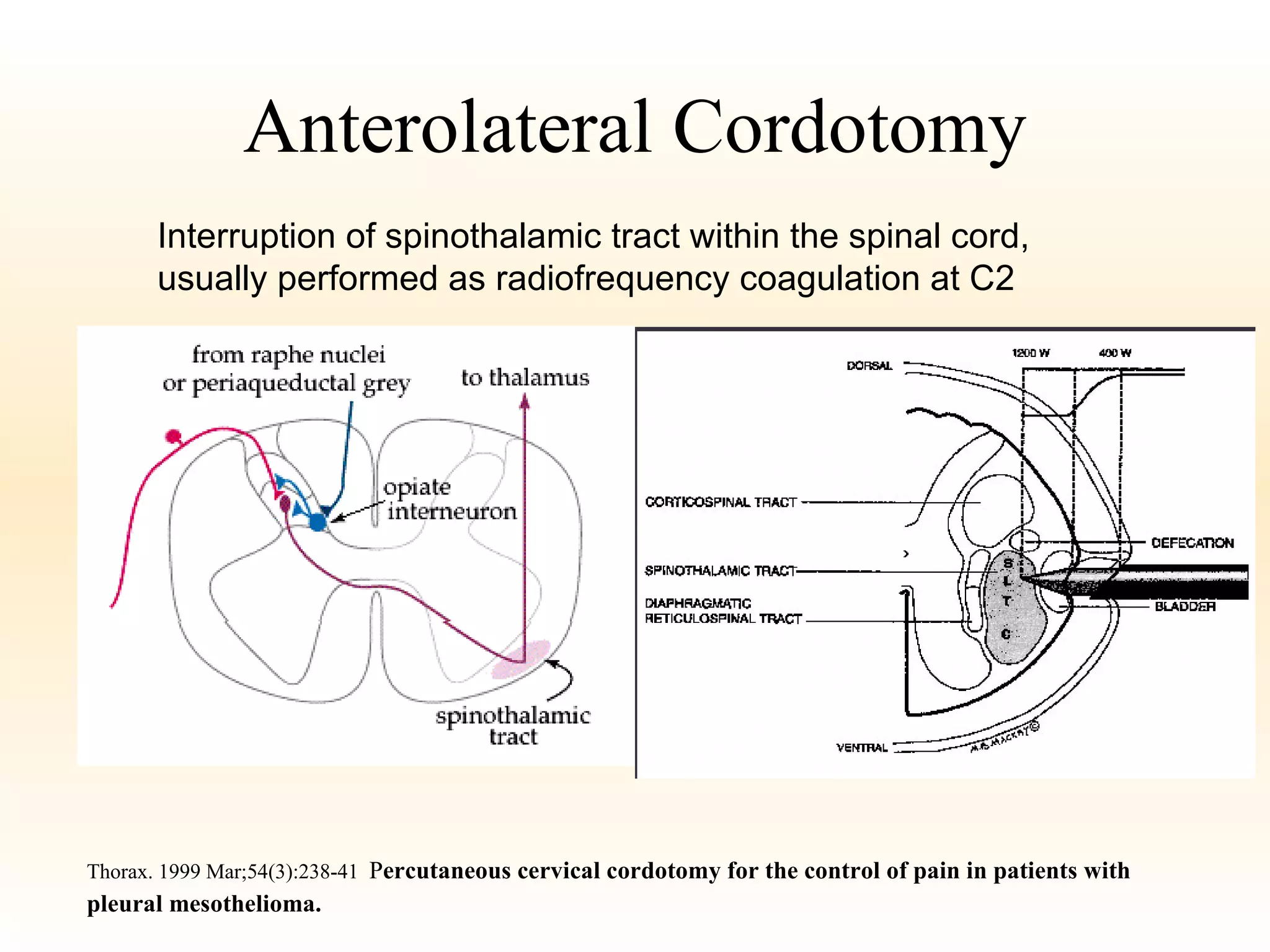 Anterolateral Cordotomy Thorax. 1999 Mar;54(3):238-41   P ercutaneous cervical cordotomy for the control of pain in patients with pleural mesothelioma. Interruption of spinothalamic tract within the spinal cord, usually performed as radiofrequency coagulation at C2 