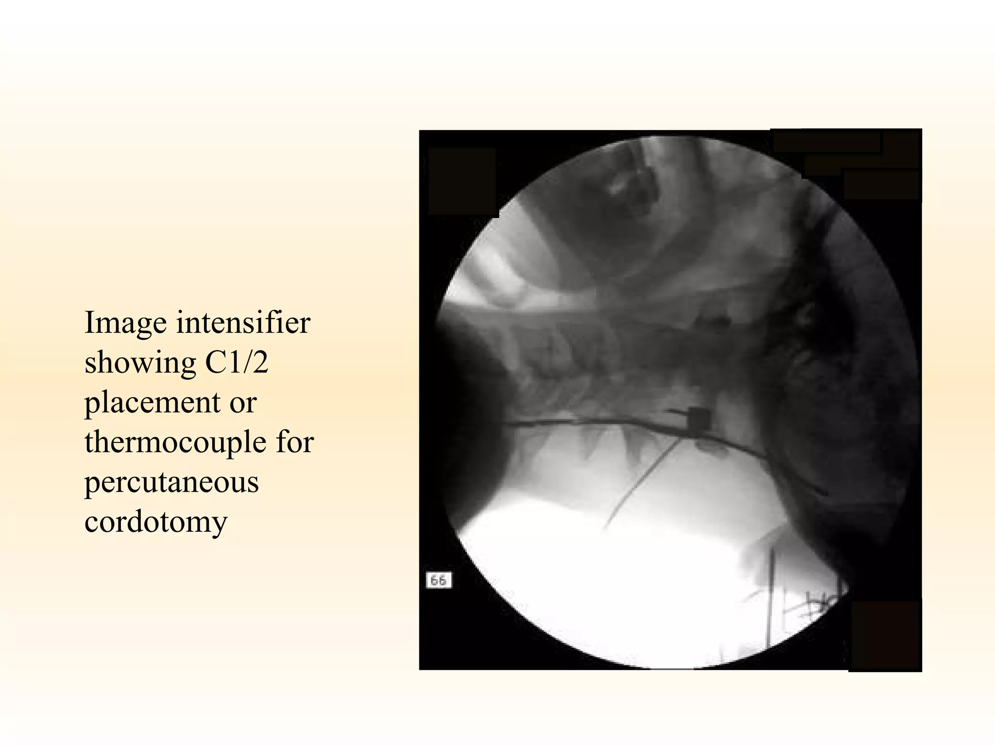 Image intensifier showing C1/2 placement or thermocouple for percutaneous  cordotomy 