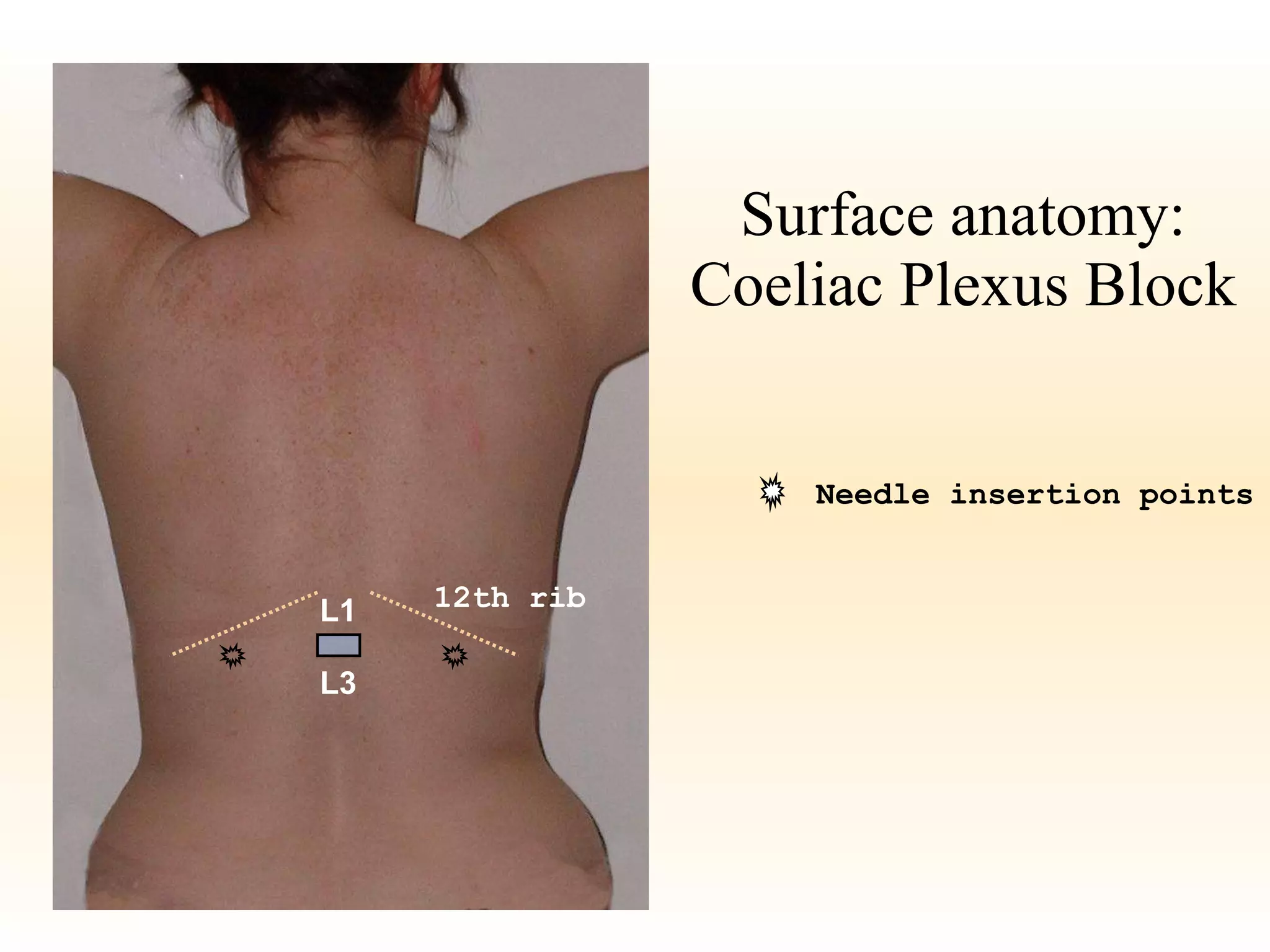 Surface anatomy: Coeliac Plexus Block Needle insertion points 12th rib L1 L3 
