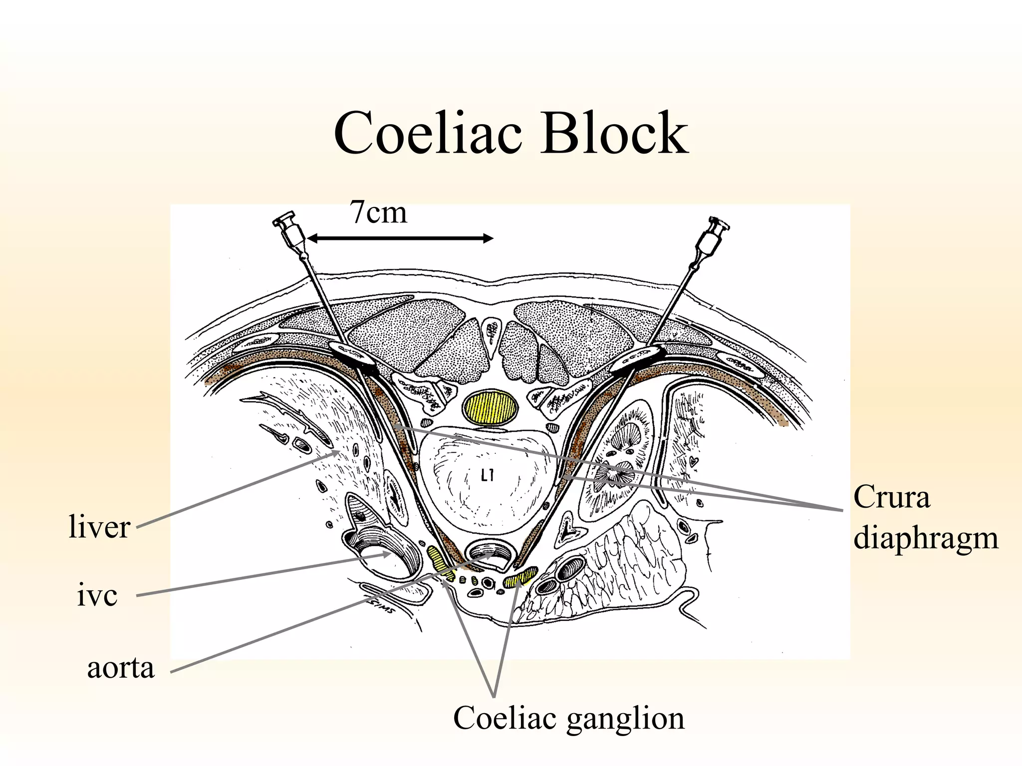 Coeliac Block Coeliac ganglion aorta ivc liver Crura  diaphragm 7cm 