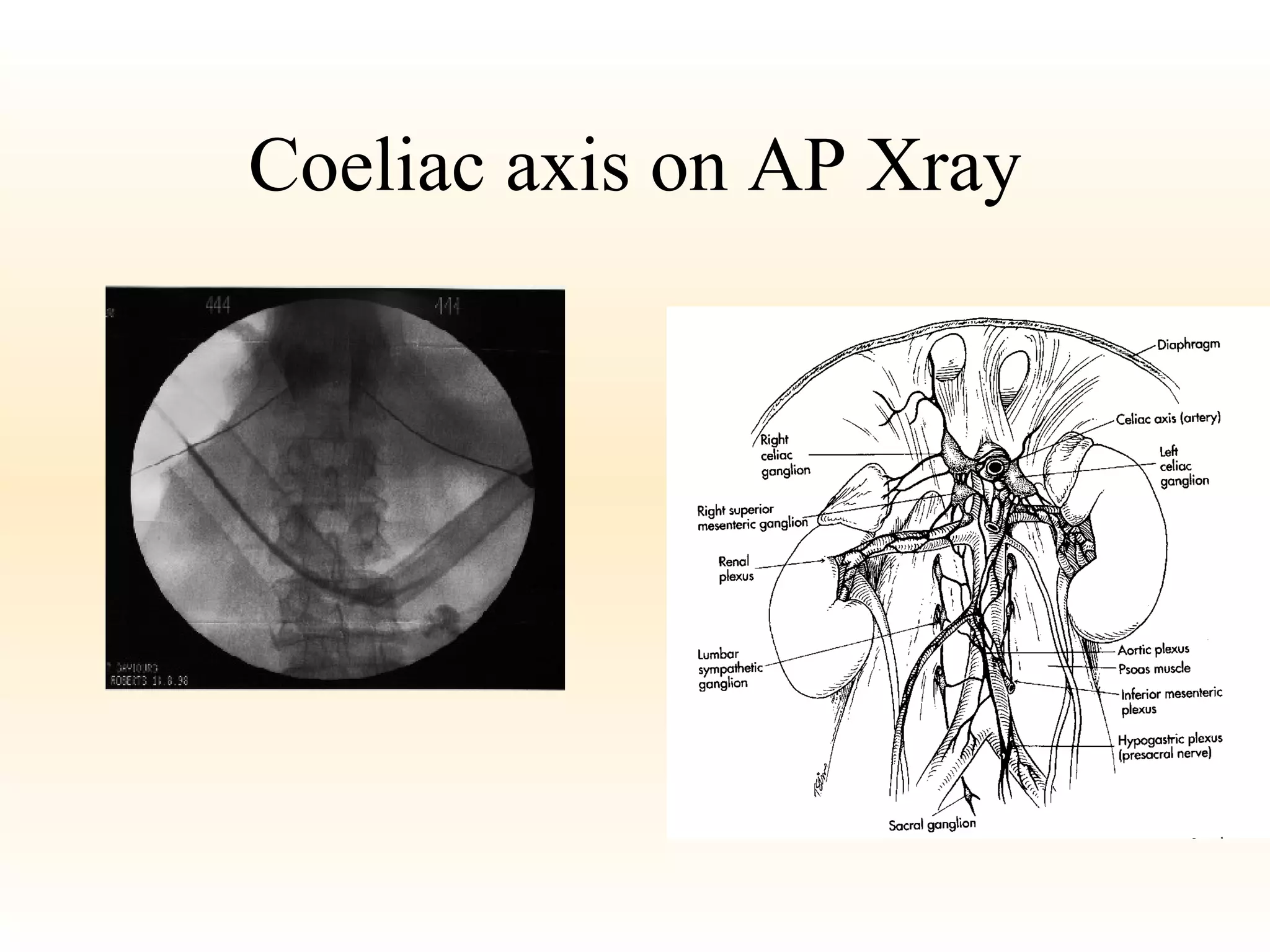 Coeliac axis on AP Xray 