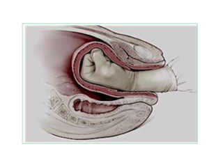 Inversion of the uterus | PPT