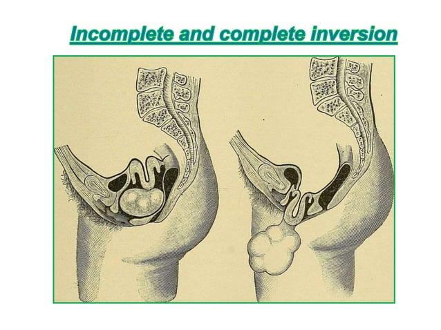 Inversion of the uterus | PPT | Pregnancy | Reproductive Health