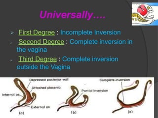 Inversion of uterus-170225210149-converted.pptx