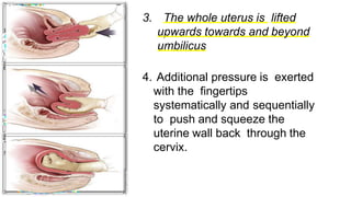 3. The whole uterus is lifted
upwards towards and beyond
umbilicus
4. Additional pressure is exerted
with the fingertips
systematically and sequentially
to push and squeeze the
uterine wall back through the
cervix.
 