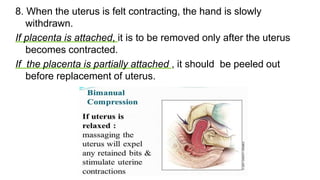 8. When the uterus is felt contracting, the hand is slowly
withdrawn.
If placenta is attached, it is to be removed only after the uterus
becomes contracted.
If the placenta is partially attached , it should be peeled out
before replacement of uterus.
 
