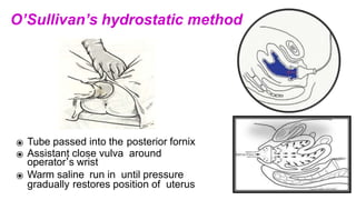 ⦿ Tube passed into the posterior fornix
⦿ Assistant close vulva around
operator’s wrist
⦿ Warm saline run in until pressure
gradually restores position of uterus
O’Sullivan’s hydrostatic method
 