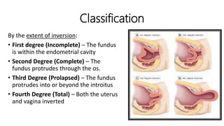 Classification
By the extent of inversion:
• First degree (Incomplete) – The fundus
is within the endometrial cavity
• Second Degree (Complete) – The
fundus protrudes through the os.
• Third Degree (Prolapsed) – The fundus
protrudes into or beyond the introitus
• Fourth Degree (Total) – Both the uterus
and vagina inverted
 