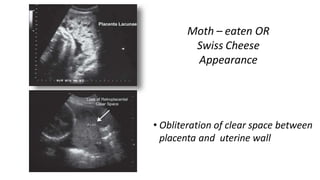 Moth – eaten OR
Swiss Cheese
Appearance
• Obliteration of clear space between
placenta and uterine wall
 