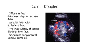 Colour Doppler
 Diffuse or focal
intraparenchymal lacunar
flow.
 Vascular lakes with
turbulent flow.
 Hypervascularity of serosa-
bladder interface.
 Prominent subplacental
venous complex.
 