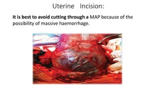 Uterine Incision:
It is best to avoid cutting through a MAP because of the
possibility of massive haemorrhage.
 