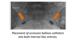 Placement of occlusion balloon catheters
into both internal iliac arteries.
 