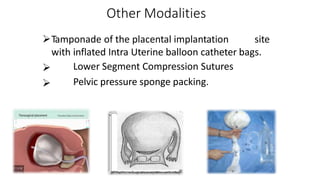 Other Modalities


Tamponade of the placental implantation site
with inflated Intra Uterine balloon catheter bags.
Lower Segment Compression Sutures
Pelvic pressure sponge packing.
 