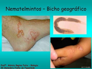 Nematelmintos – Bicho geográfico 