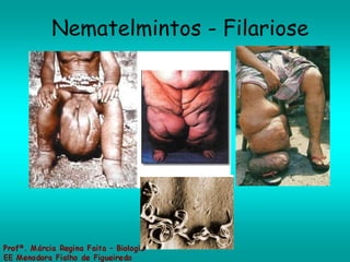 Nematelmintos - Filariose 
