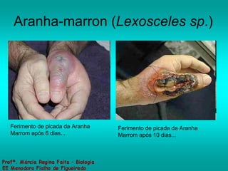 Aranha-marron ( Lexosceles sp .) Ferimento de picada da Aranha Marrom após 6 dias...  Ferimento de picada da Aranha Marrom após 10 dias...  