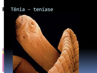 Tênia - teníase
 