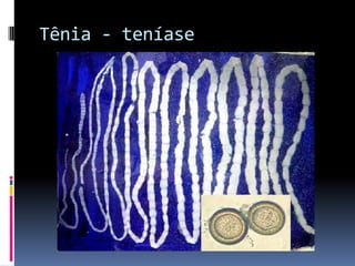 Tênia - teníase
 