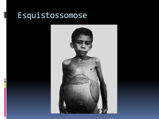 Esquistossomose
 