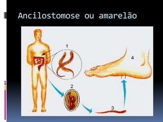 Ancilostomose ou amarelão
 